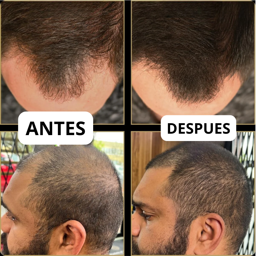 Tiveno™ - Pigmento Capilar Masculino - Efecto 7 dias (Importado)