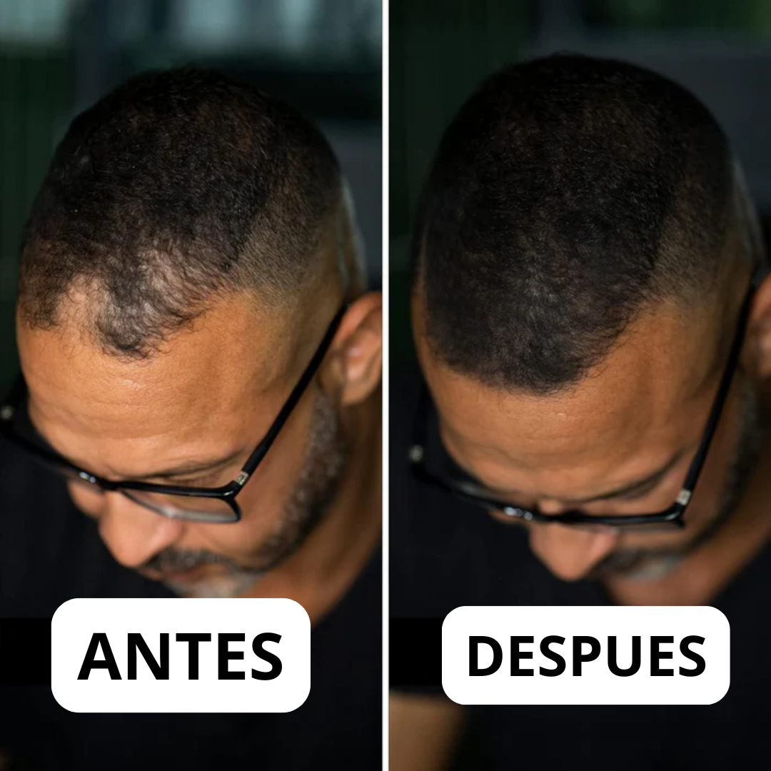 Tiveno™ - Pigmento Capilar Masculino - Efecto 7 dias (Importado)